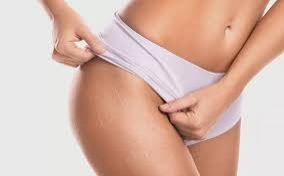 Especialista explica como se prevenir das estrias