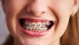 Por que os dentes voltam a entortar após o uso de aparelho ortodôntico